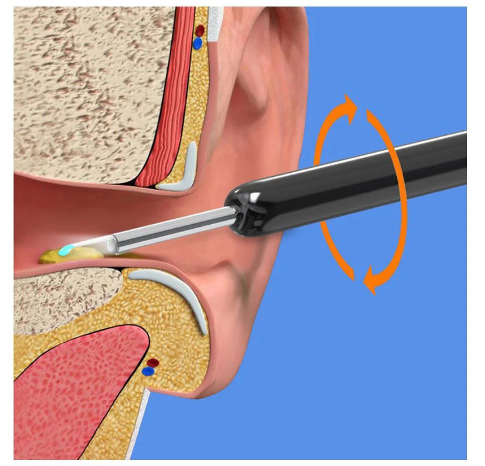 Earwax Removal Kita